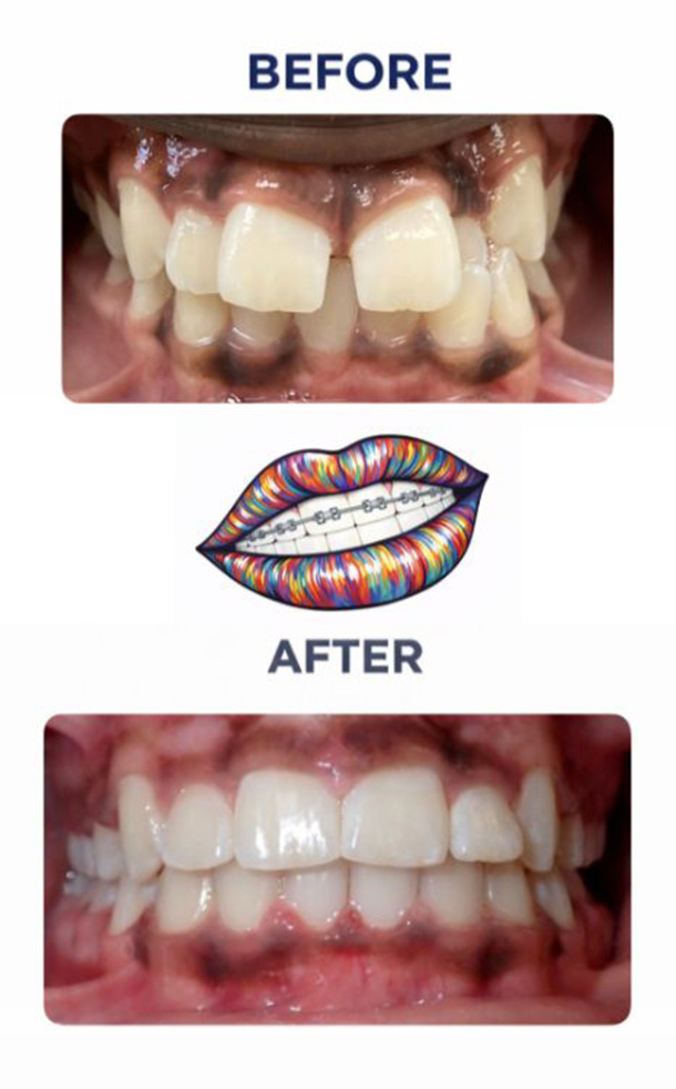 Before and After Photo