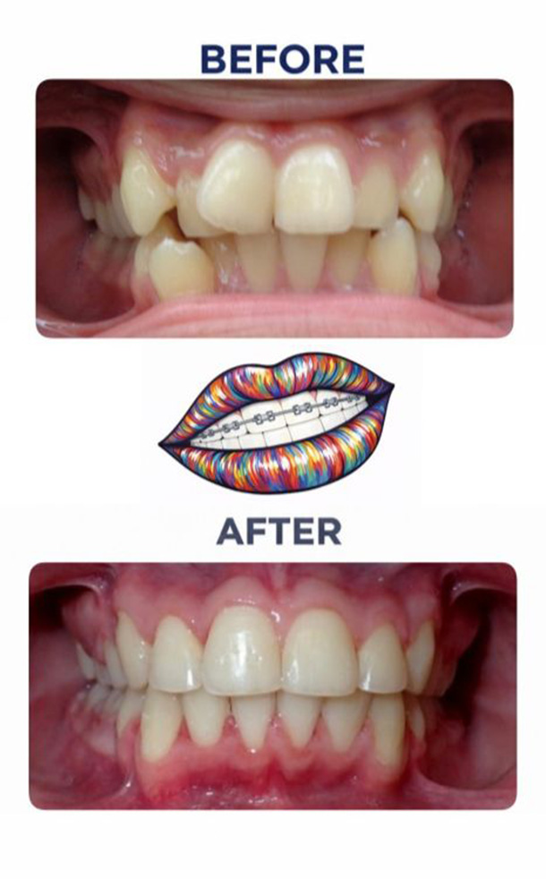 Before and After Photo