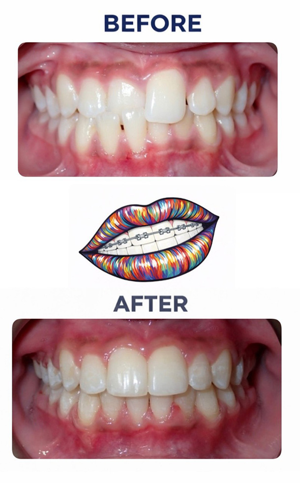 Crossbite Before and After Photo