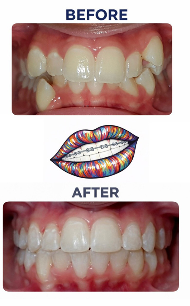 Crowding Before and After Photo