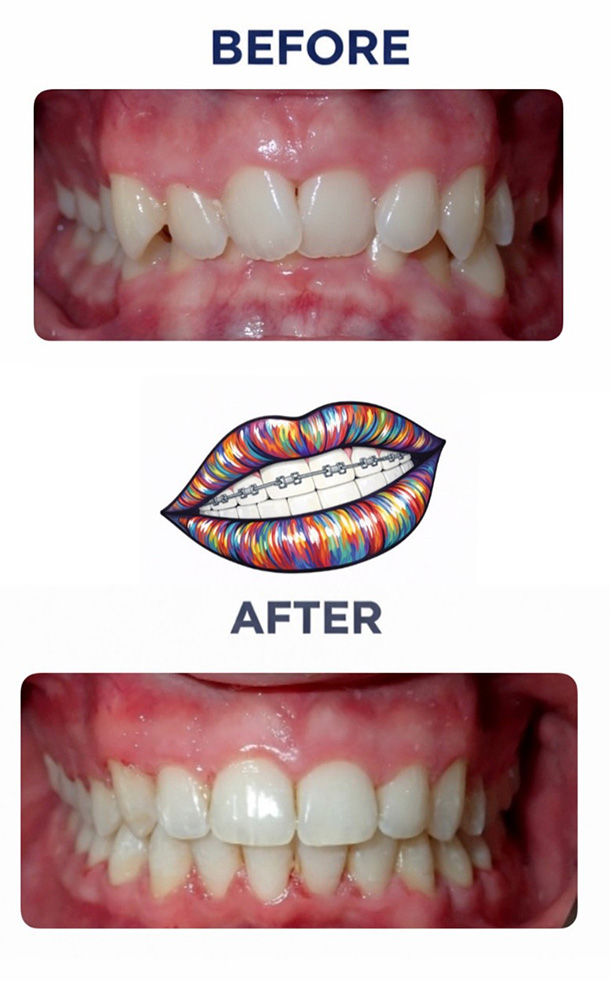 Deep Bite Before and After Photo