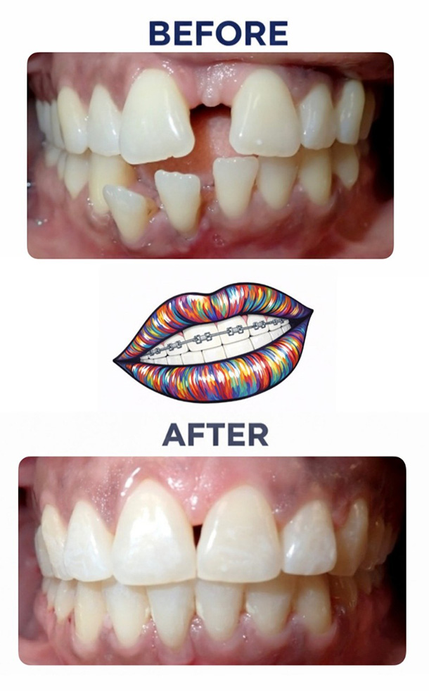 Flared Teeth Before and After Photo
