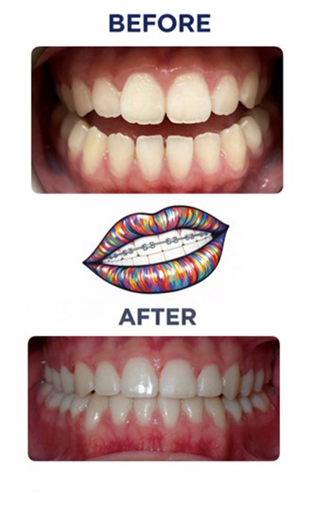 Open Bite Before and After Photo