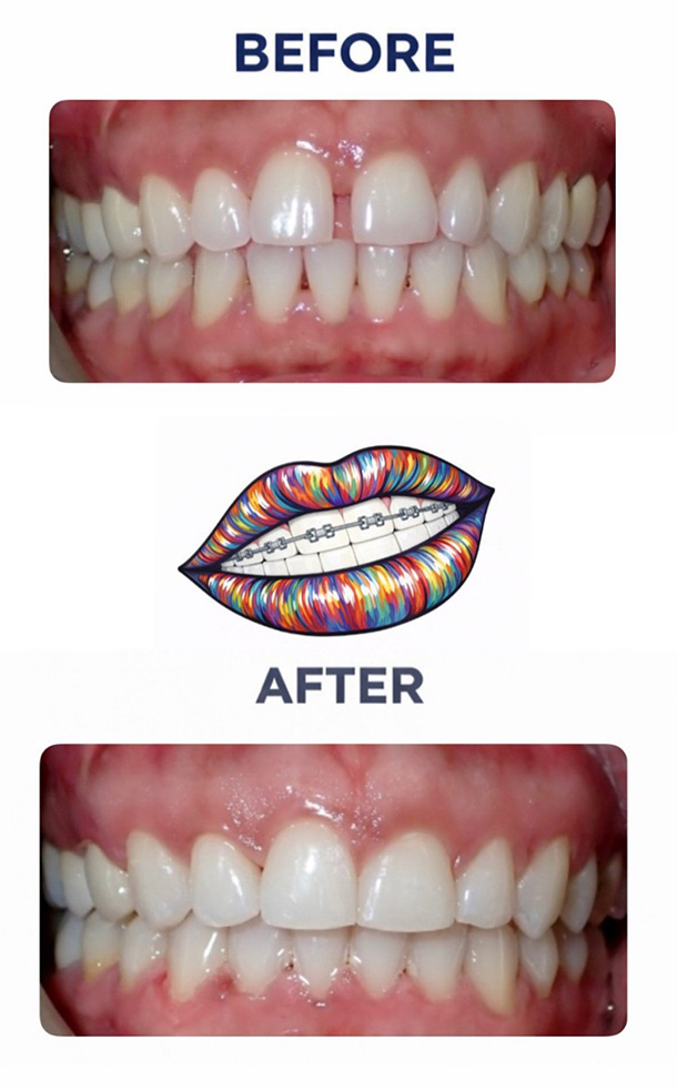Spacing Before and After Photo