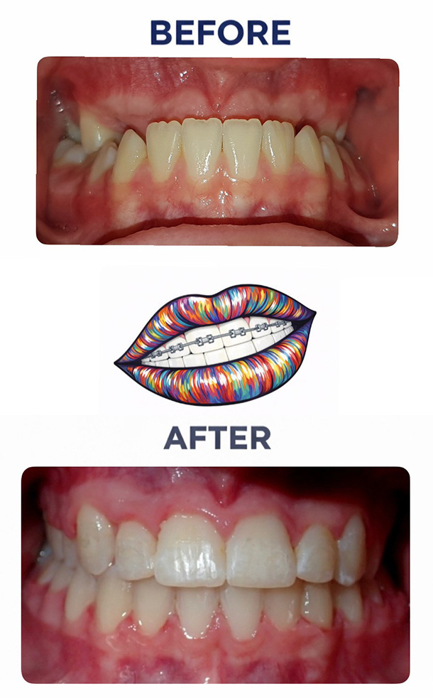 Underbite Before and After Photo