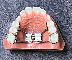 palatal expander