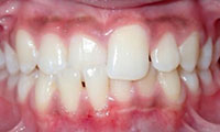 non braces treatment before
