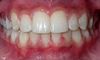 non braces treatment after