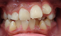 crowding of the teeth before