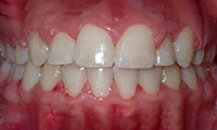 crowding of the teeth after