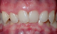 deep overbite before