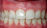 deep overbite after