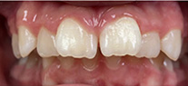 overjet before