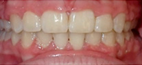 overjet after