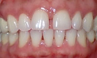 spacing of teeth before