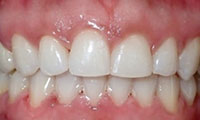 spacing of teeth after