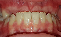 underbite before