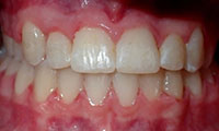 underbite after