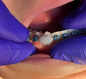 Wax on poking wire
